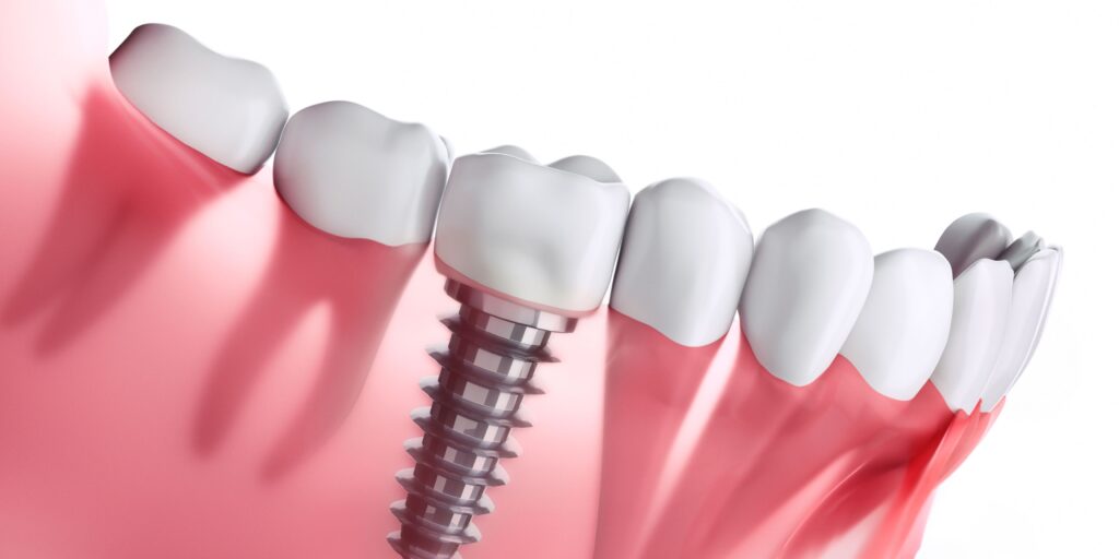 implantes dentales tenerife